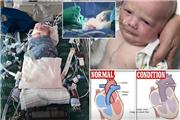نخستین پیوند بافت زنده قلب در جهان جان یک نوزاد را نجات داد