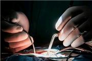 انجام اولین عمل جراحی مغز در اندیمشک